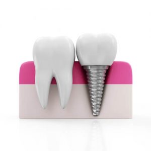 Dental Implants Fort Lauderdale