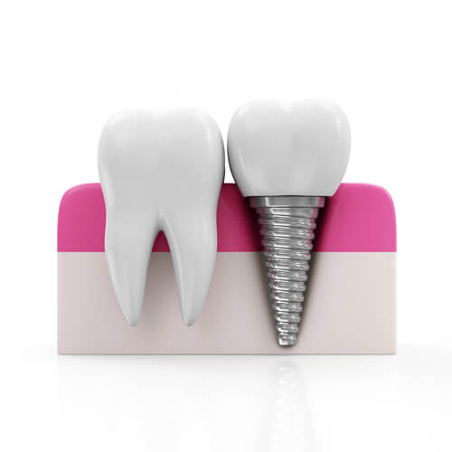 dental-implant-service-img