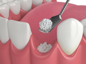 Bone Grafting - Pre-Surgical Treatment for Dental Implant