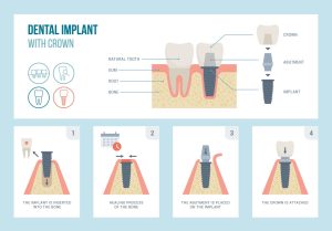 Components of a Dental Implant with Crown