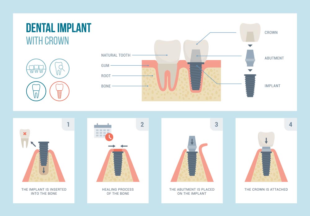 Components of a Dental Implant with Crown Hart to Hart Dental