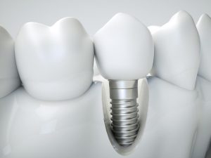 Dental Implant Insertion Process