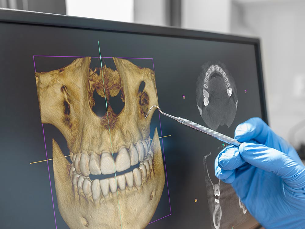 3D Imaging - Dental Implant Treatment Planning