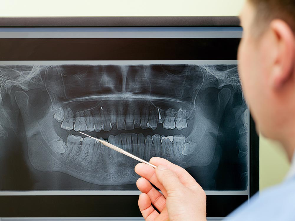Digital X-Rays - Dental Implant Treatment Planning