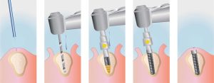 How Dental Implants Work