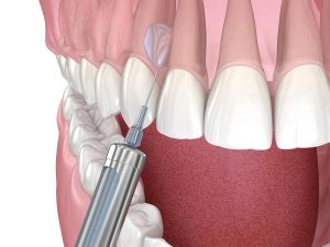 Administration of Local Anesthesia before Dental Implant Procedure
