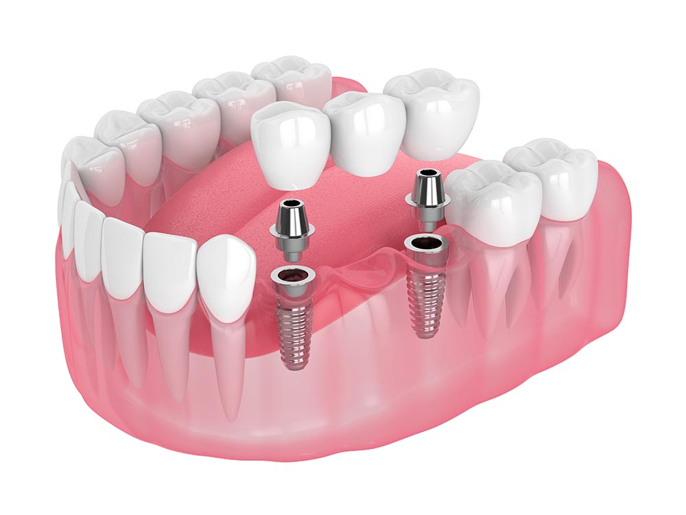 Multiple Missing Teeth Replaced with Dental Implant and Crown with Bridge