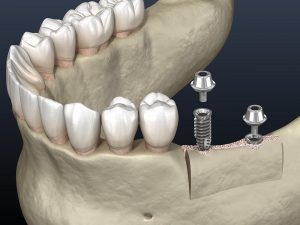 Ridge Augmentation - Pre-Surgical Treatment for Dental Implant