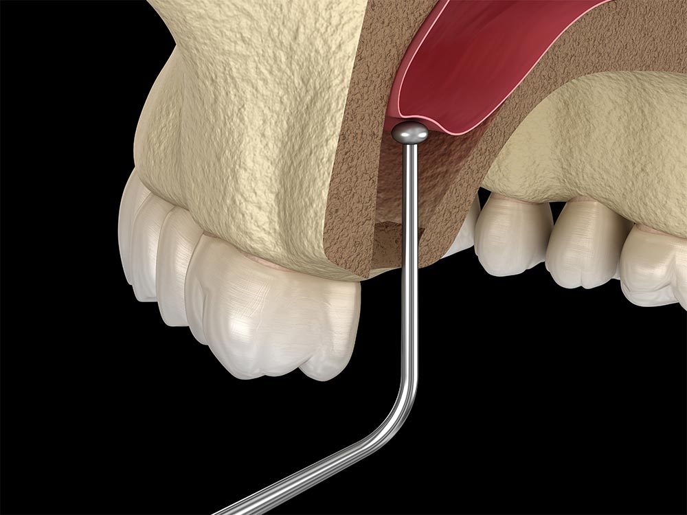 Sinus Lift Procedure - Pre-Surgical Treatment for Dental Implant