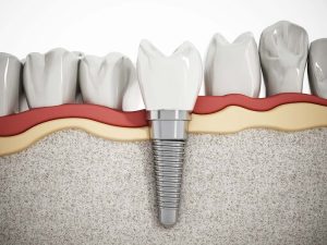 The Ultimate Guide to Dental Implants Fort Lauderdale