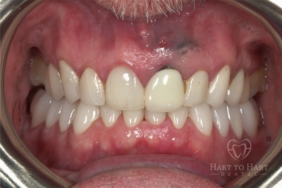 patient-gallery-case-7-before-img