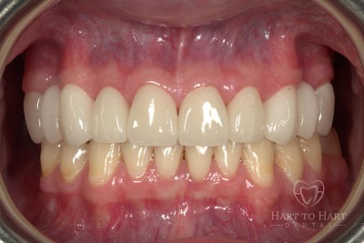 patient-gallery-case-4-after-img