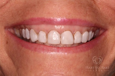 patient-gallery-case-5-before-img