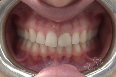 patient-gallery-case-3-before-img