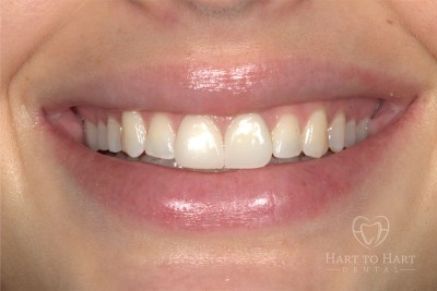 patient-gallery-case-3-after-img