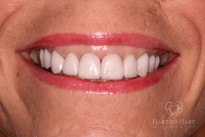 patient-gallery-case-5-after-img