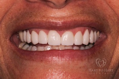 dental-veneers-after-img1-case1