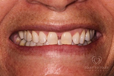dental-veneers-before-img1-case1
