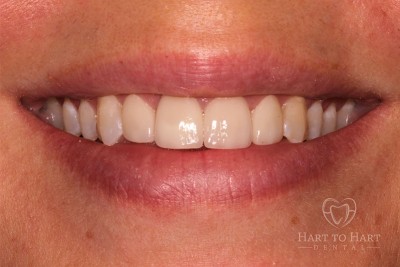 patient-gallery-case-2-after-img