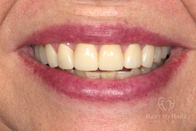 patient-gallery-case-6-after-img