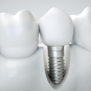 Dental Implant Insertion Process