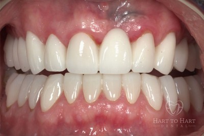 patient-gallery-case-7-after-img