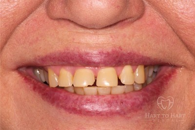 patient-gallery-case-6-before-img