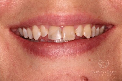 patient-gallery-case-2-before-img