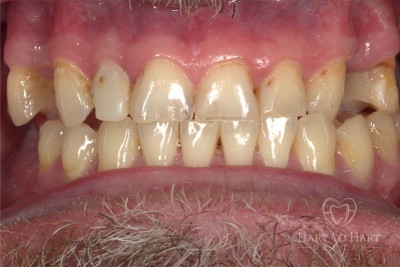 patient-gallery-case-4-before-img